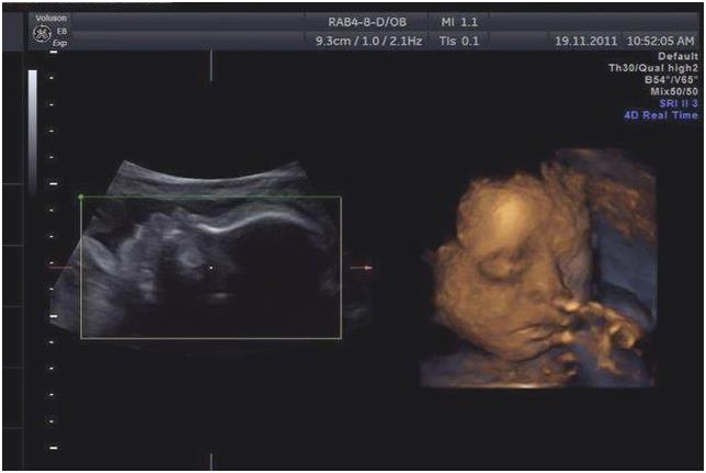 孕检结果正常，却生出畸形宝宝，怀孕多少周做排畸检查准确率最高