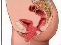 研究质疑分娩方式与盆底症状之间的关系