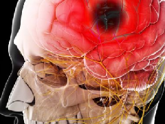 研究发现流产和死产与中风风险增加有关