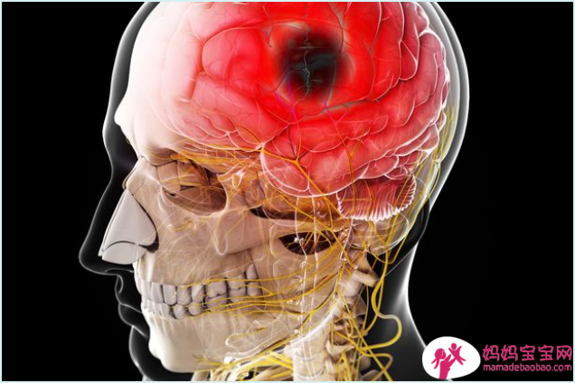 研究发现流产和死产与中风风险增加有关