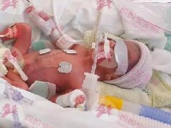 世界早产儿日｜台妈分享「14cm袖珍宝宝」早产经历