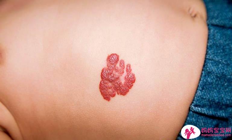 上天的礼物「婴儿血管瘤」！认识病程2周期＆治疗3情况