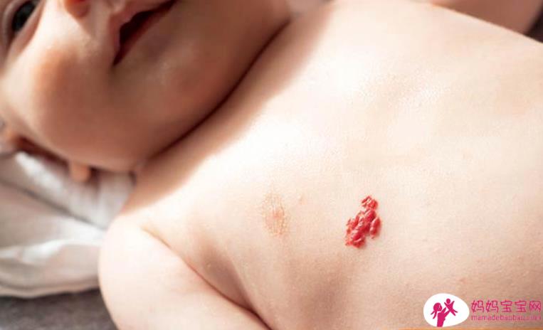 上天的礼物「婴儿血管瘤」！认识病程2周期＆治疗3情况