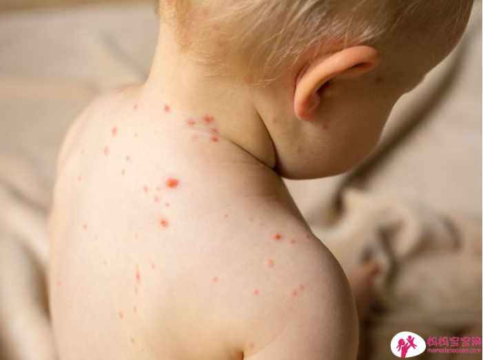 宝宝疹子分辨，肠病毒、玫瑰疹、水痘⋯照护全攻略
