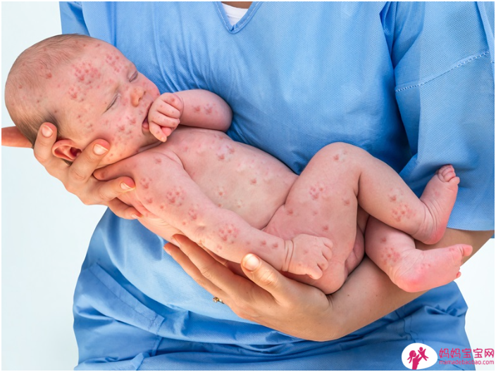 宝宝疹子分辨，肠病毒、玫瑰疹、水痘⋯照护全攻略