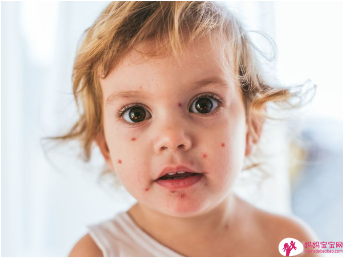 宝宝疹子分辨，肠病毒、玫瑰疹、水痘⋯照护全攻略