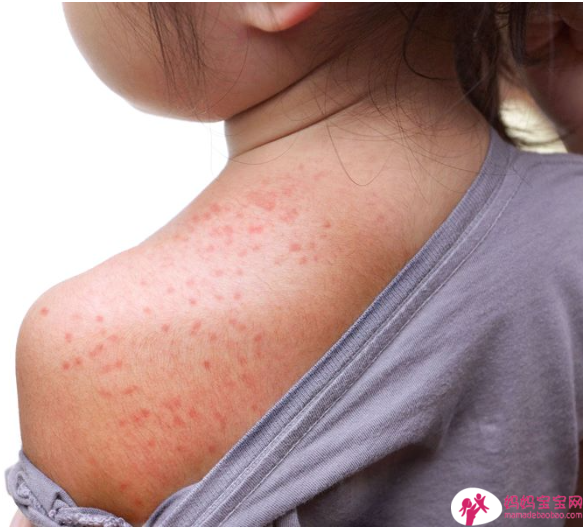 宝宝疹子分辨，肠病毒、玫瑰疹、水痘⋯照护全攻略