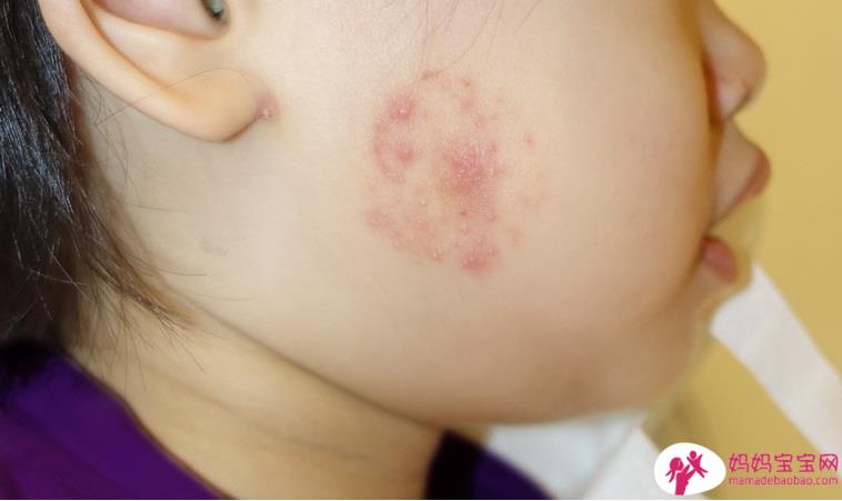 幼儿使用贴布要小心！1岁半女娃止痒不成起脓疱