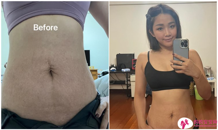 艺人赖慧如晒妊娠纹照曝：没自信、曾有产后忧郁症