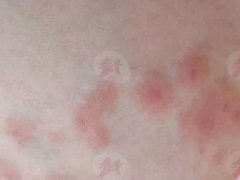 哺乳期间乳头发红怎么办？