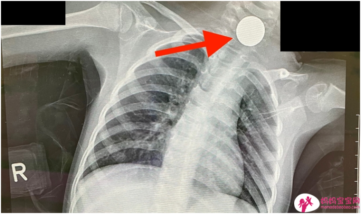 2岁童持续作呕！照X光惊见危险异物险送命