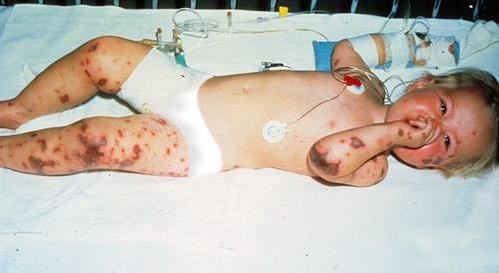 四价疫苗不够用!脑脊髓膜炎婴幼儿死亡率达四成