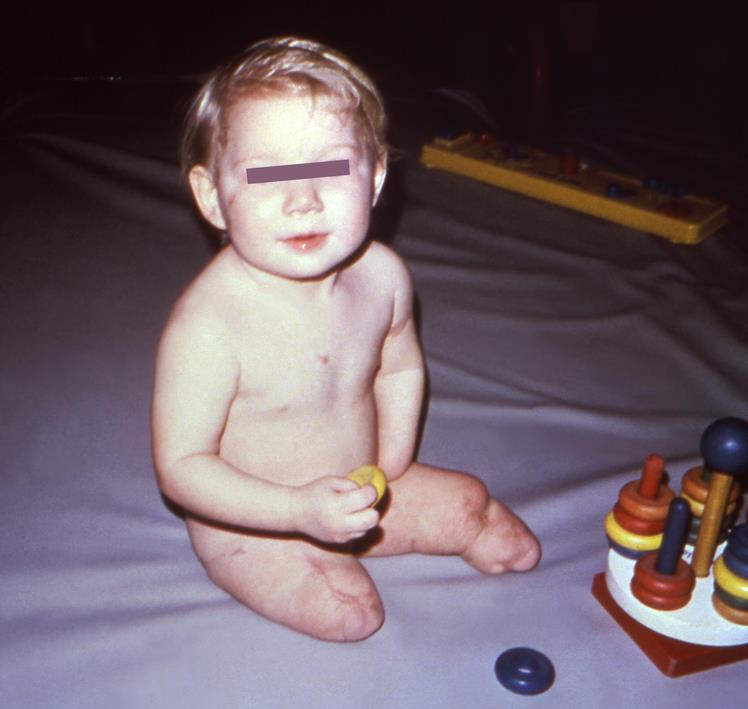 四价疫苗不够用!脑脊髓膜炎婴幼儿死亡率达四成