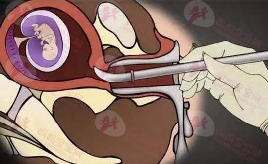 堕胎周期及后遗症（「药物流产」及「手术流产」）