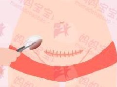 剖腹产伤口怎么顾才好的快?公开9个剖腹产伤口照护疑问