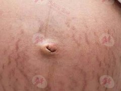 预防妊娠纹，孕期保养不能偷懒！「先油再霜」一起擦，肌肤才能光滑不留痕