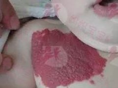 婴儿血管肿瘤治不治？药物有效且安全性高．不让不雅外观成遗憾