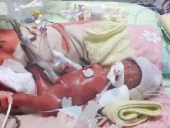 早产威胁宝宝健康协和医院专家：预防早产需做好孕期健康管理