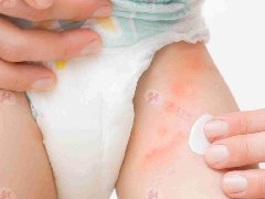 尿布疹发生的原因是什么？