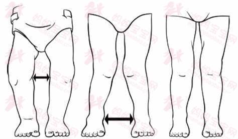 宝宝为什么会有O型腿？穿纸尿裤会导致O型腿吗？