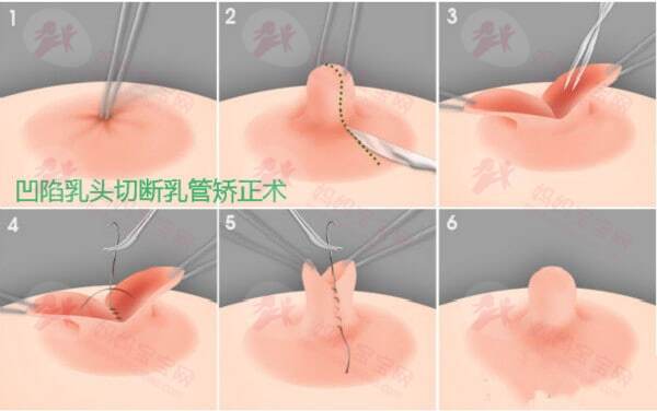 乳头内陷自己怎么矫正过来