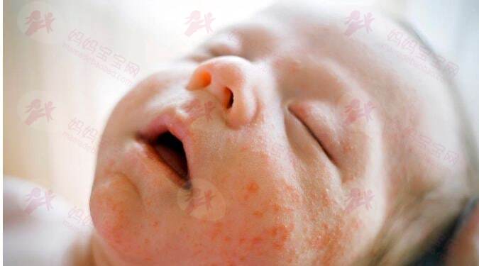 湿疹护理难？除了膏药，还有这些护理方法一定要注意