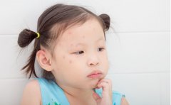 别误认成毛囊炎!孩子皮肤出现珍珠串小疹是(传染性软疣病毒)