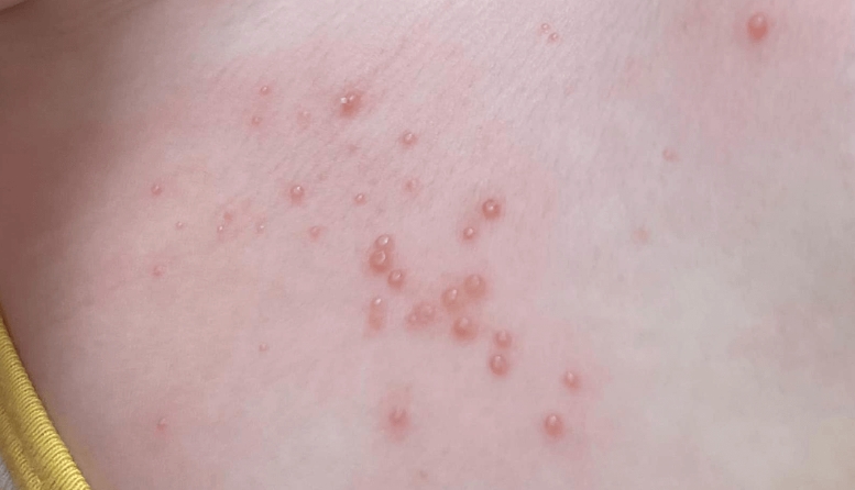 别误认成毛囊炎！孩子皮肤出现珍珠串小疹是（传染性软疣病毒）