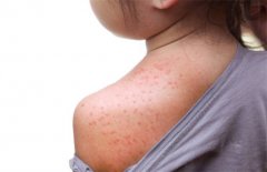 有一种冷叫大人觉得冷天凉宝 宝却热疹却冒不停,儿科医:穿太多啦