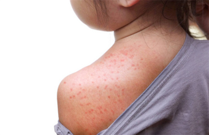 有一种冷叫大人觉得冷天凉宝 宝却热疹却冒不停,儿科医:穿太多啦