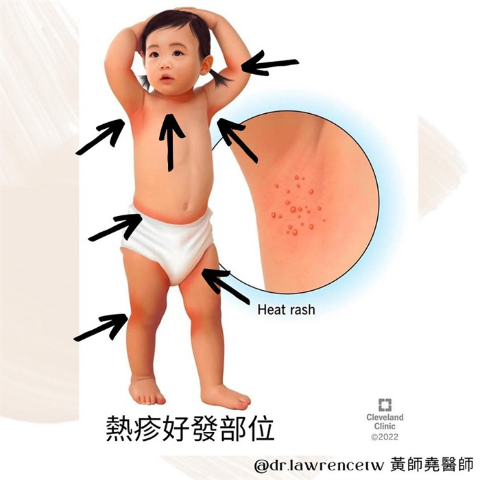 有一种冷叫大人觉得冷天凉宝 宝却热疹却冒不停,儿科医:穿太多啦