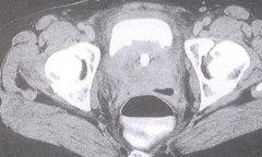 女性尿道瘤的症状有哪些