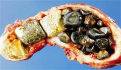 胆结石的病因有哪些