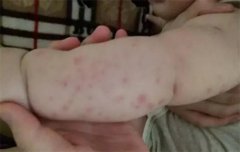 宝宝螨虫过敏的症状有哪些？