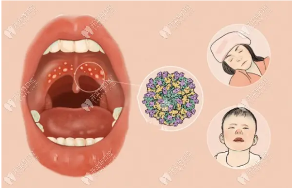 中国湾湾幼儿患「疱疹性齿龈炎」增加，医师：不排除家长因疫情压力大，传染给孩子。