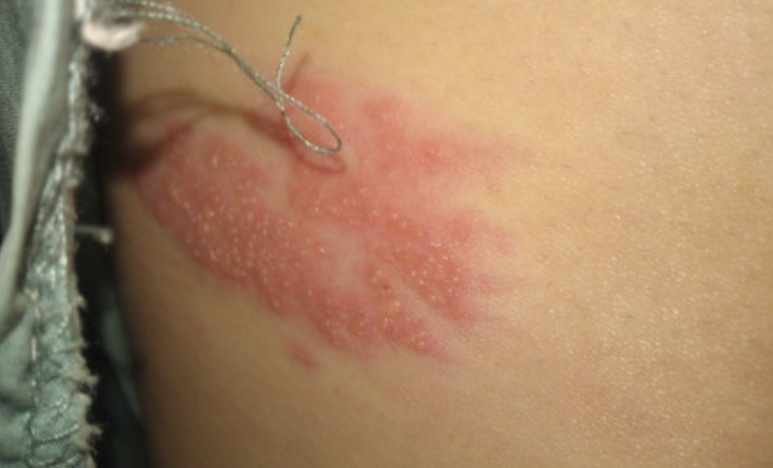 孩子去公园小心「毛毛虫皮肤炎」!红疹剧痒严重恐休克,没接触毛毛虫也会得!