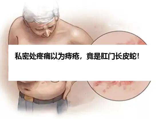 私密处疼痛以为痔疮，竟是肛门长皮蛇！