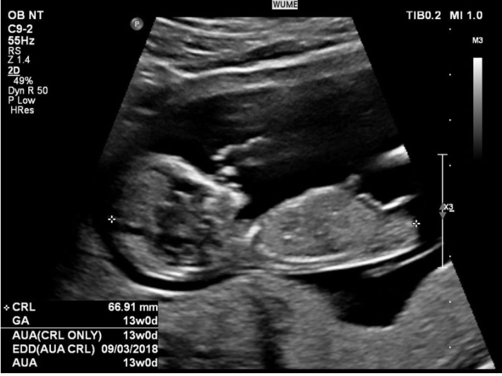  孕妇需要了解B超时胎儿指标的意义