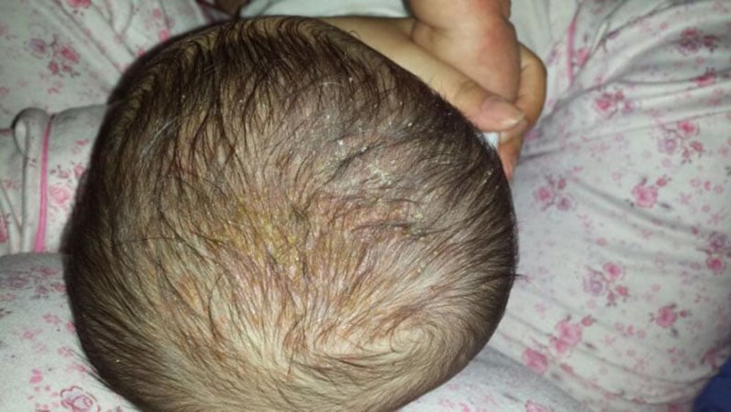 婴儿水牛 (脂溢性皮炎): 7种简单有效的治疗方法