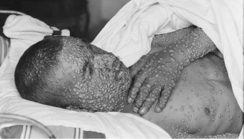 儿童天花与水痘如何区分