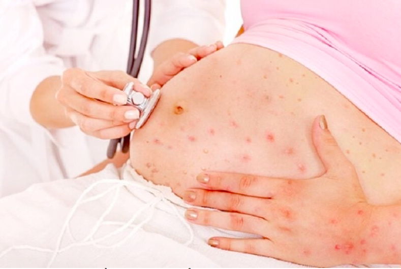 儿童天花与水痘如何区分