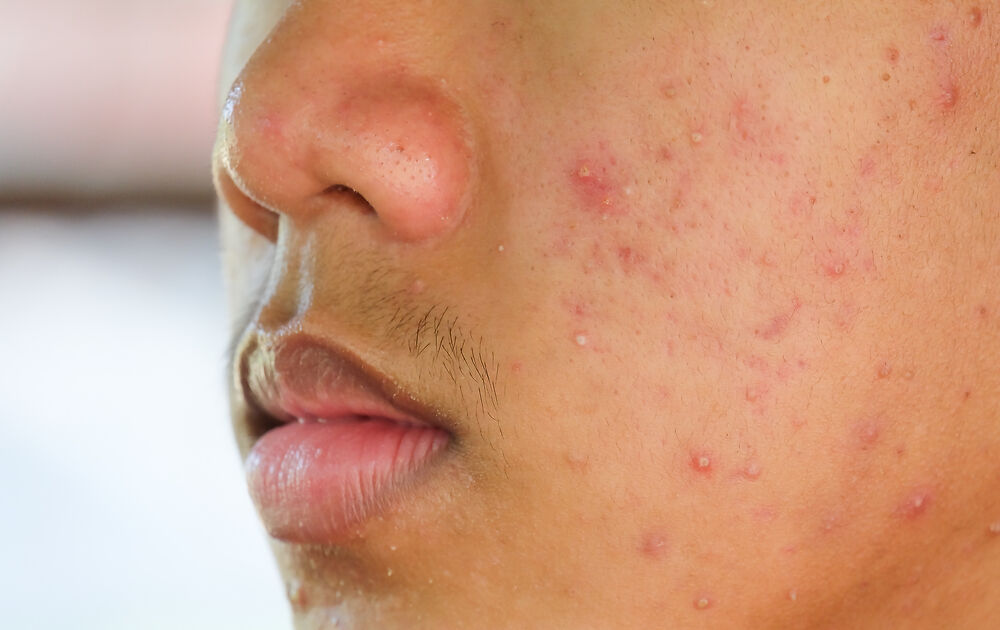 儿童性早熟: 体征,原因,治疗和预防