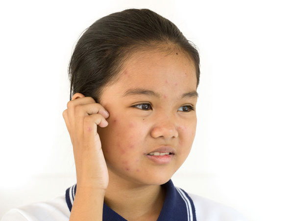 识别水痘迹象,提高预防意识