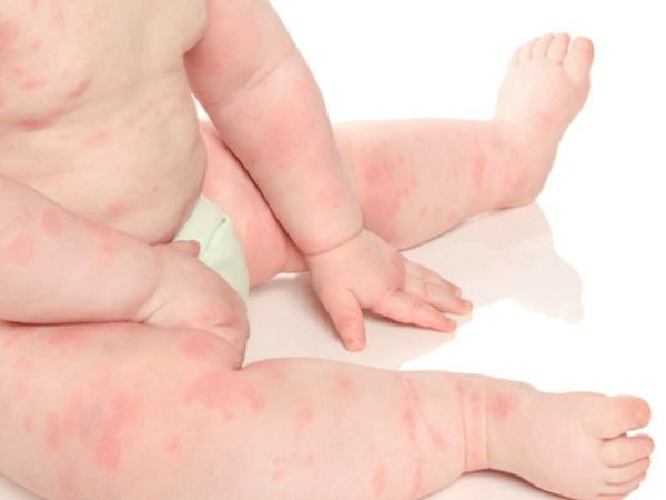 别小看儿童过敏性皮炎