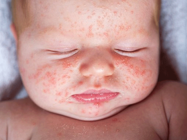新生儿红斑: 妈妈不应忽视的5个问题