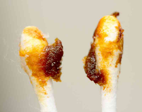 或多或少的耳垢,变色警告儿童的健康状况