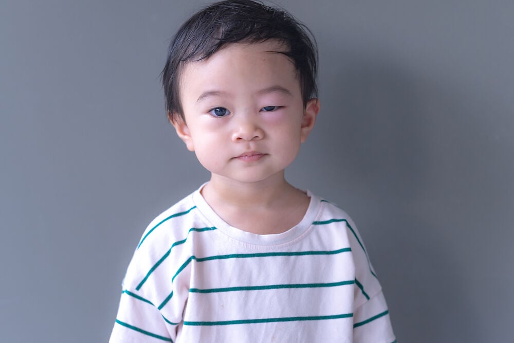 孩子眼睛浮肿是什么原因?父母应该担心吗?