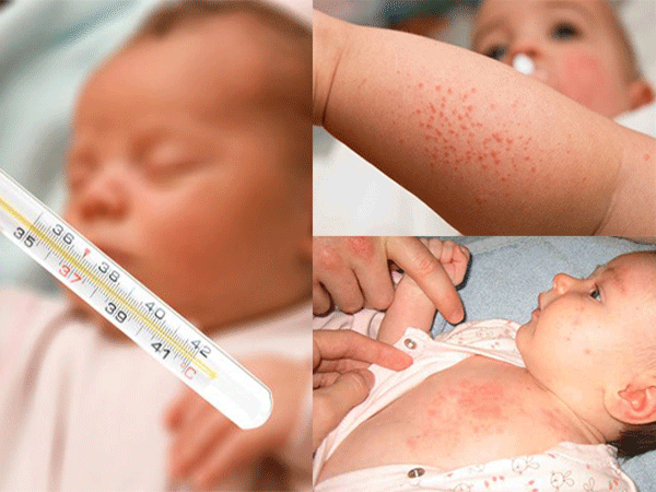新生儿红斑: 妈妈不应忽视的5个问题