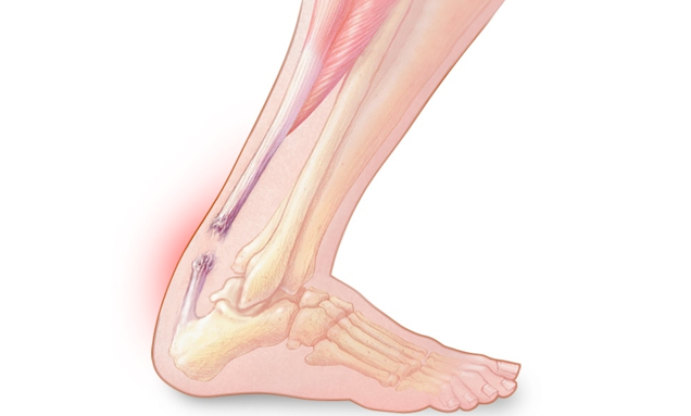 儿童扁平足综合症和妈妈需要知道的事情