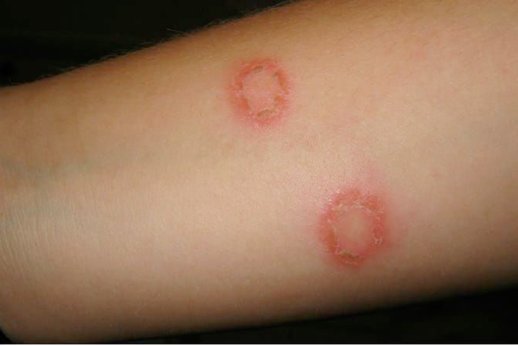 儿童癣 (体癣) 症状及治疗方法